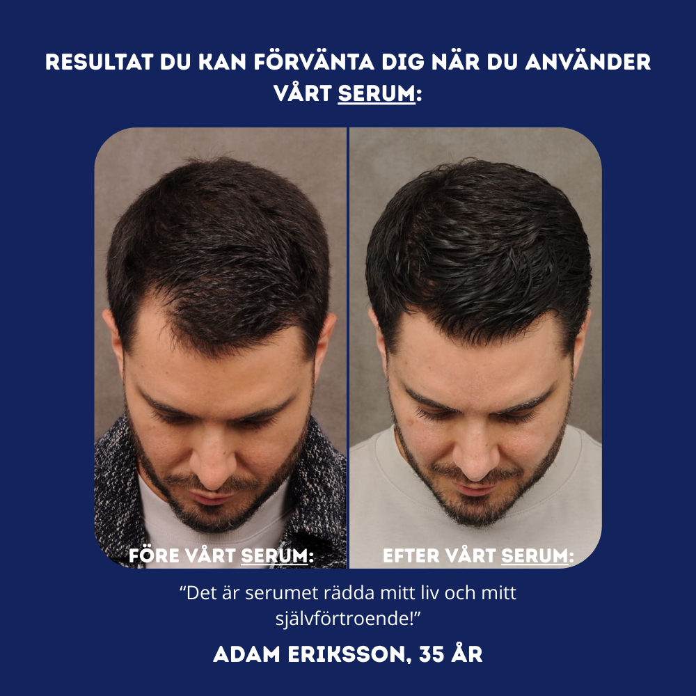 Anti Håravfalls Serum - Få tillbaka håret och självförtroendet
